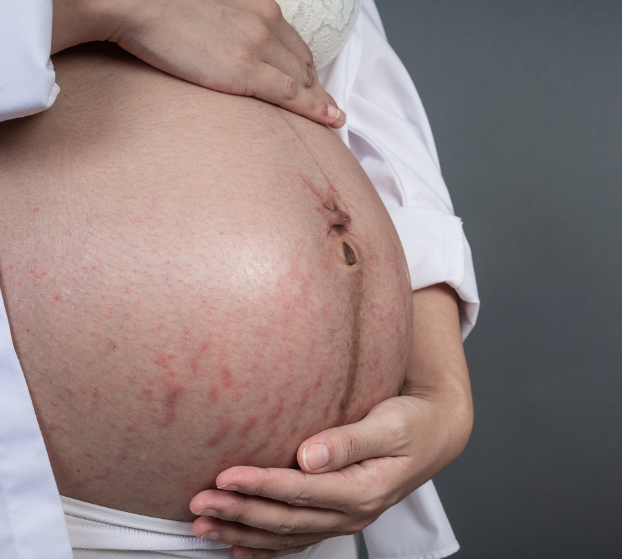 Comment éviter les vergetures liées à la grossesse ?